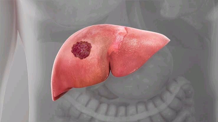 Warnings: Everyone Should Avoid Liver Cancer By Staying Away From These 4 Things